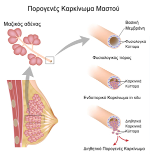 Παρογενές Καρκίνωμα Μαστού Παρογενές Καρκίνωμα Μαστού
